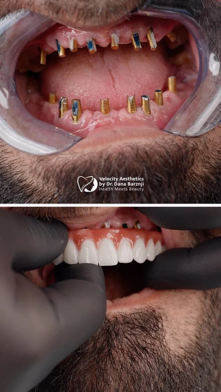 Real missing-tooth implant case documented by Dr. Dana Barznji Dental Clinic