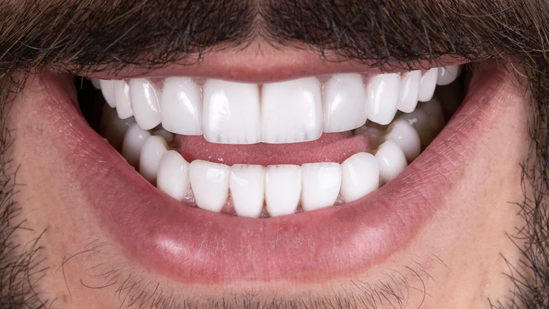 Smile photograph from the before and after collection 04